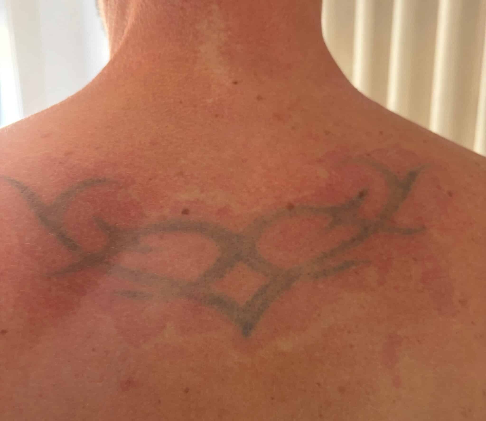 Efter 4 behandlinger