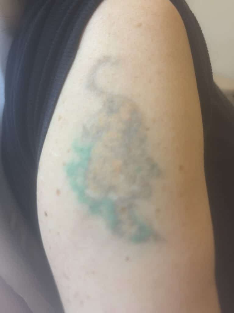 Efter 5 behandlinger