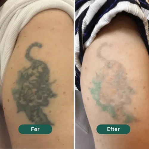 Pico Lounge Tattoo Removal - Arm