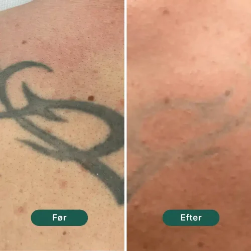 Pico Lounge Tattoo Removal - Back