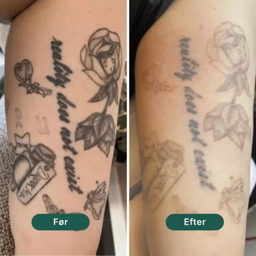 Pico Lounge Tattoo Removal - Calves