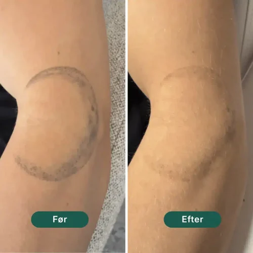 Pico Lounge Tattoo Removal - Elbow