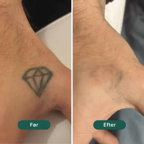 Pico Lounge Tattoo Removal - Hands