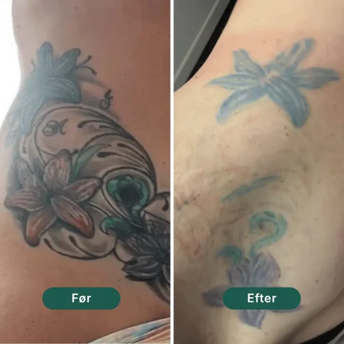Pico Lounge Tattoo Removal - Hips