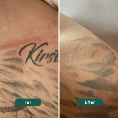 Pico Lounge Tattoo Removal - Shoulder