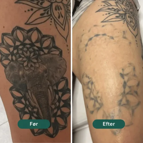 Pico Lounge Tattoo Removal - Thighs
