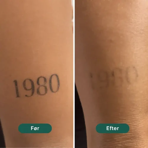 Pico Lounge Tattoo Removal - Triceps