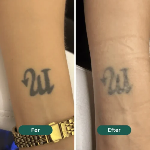 Pico Lounge Tattoo Removal - Wrists